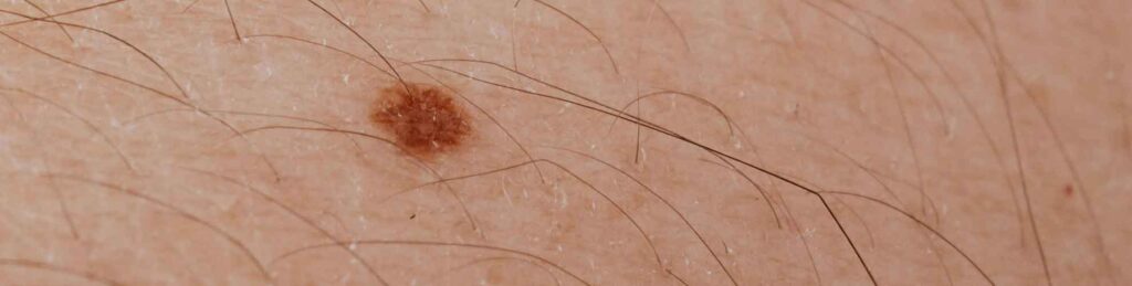 Skin Cancer Medical Witness