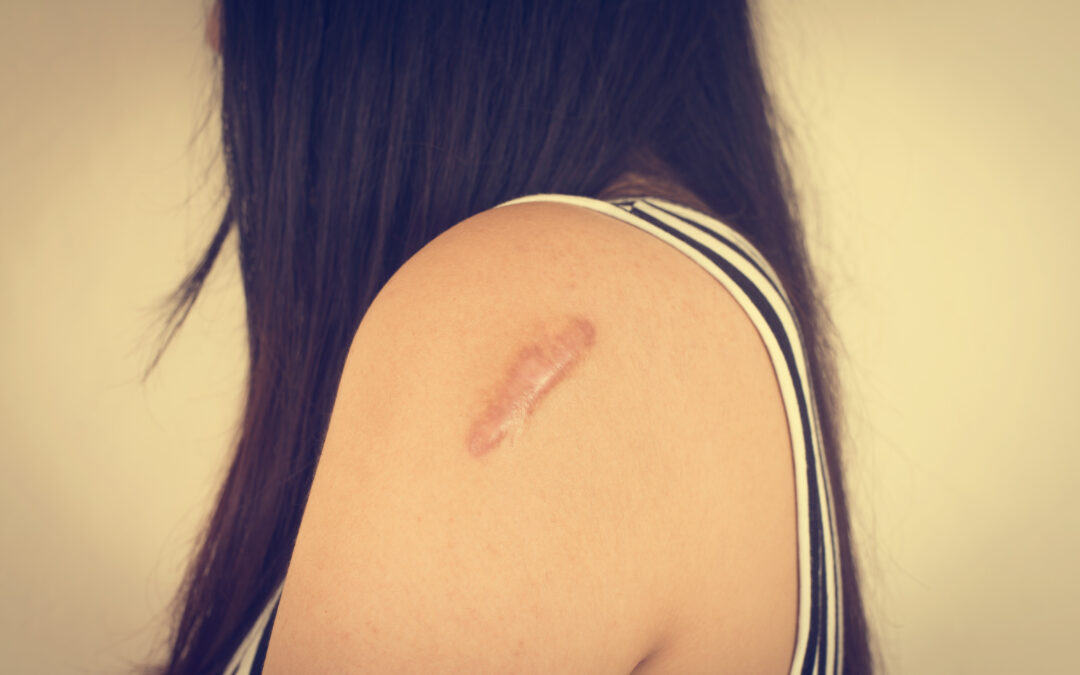 Skin Camouflage Reports Birmingham